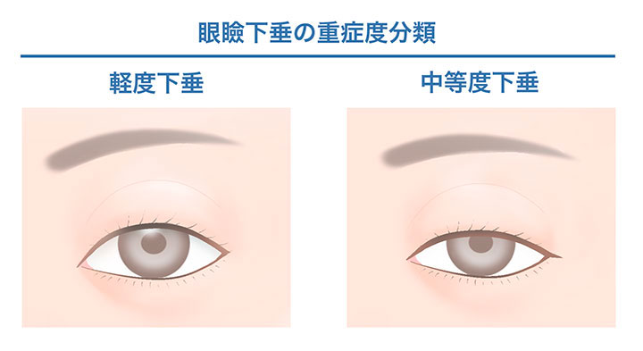 眼瞼下垂の重症度分類