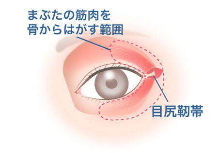 目尻靱帯移動術_2