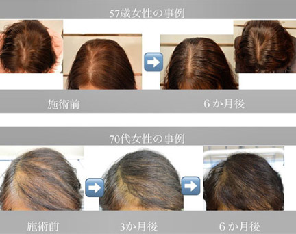 発毛治療