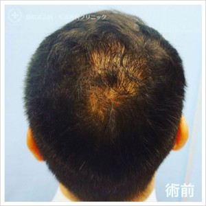 発毛治療(幹細胞培養液注入)術前