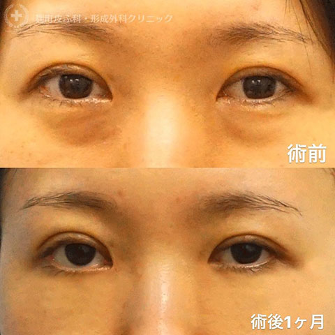 症例写真「二重埋没法」（30代女性）ぱっちり二重