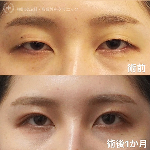 症例写真「二重埋没法」（女性）まぶたが重く開けづらい症状