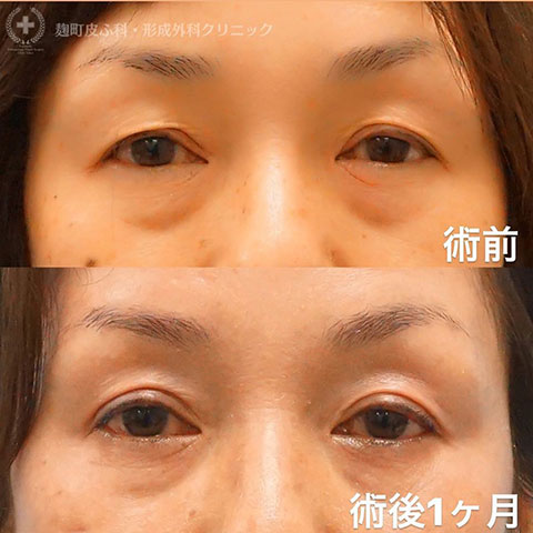 症例写真「眼瞼下垂術」[術前/1ヶ月]（40代女性）