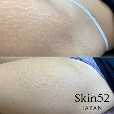 症例写真「Skin52」（女性）[術前/術直後] CASE 03