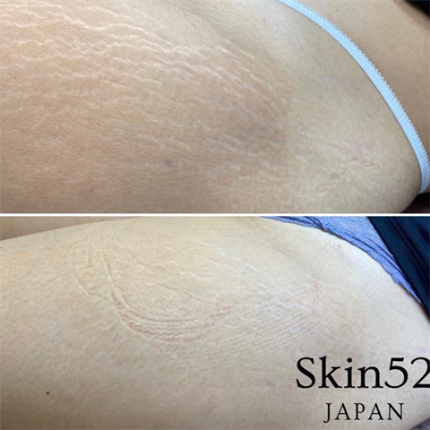 症例写真「Skin52」（女性）[術前/術直後] CASE 09